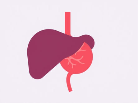 Ovarian Cancer Recurrence Ca125