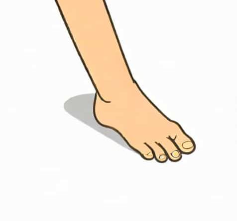 What Is Clubbed Feet